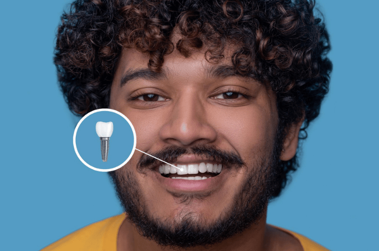 Advanced Dental Implants