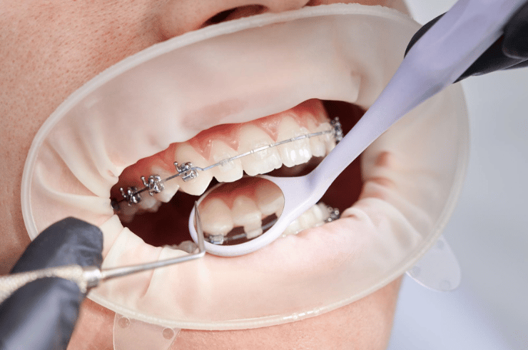 Orthodontic & Braces Treatment